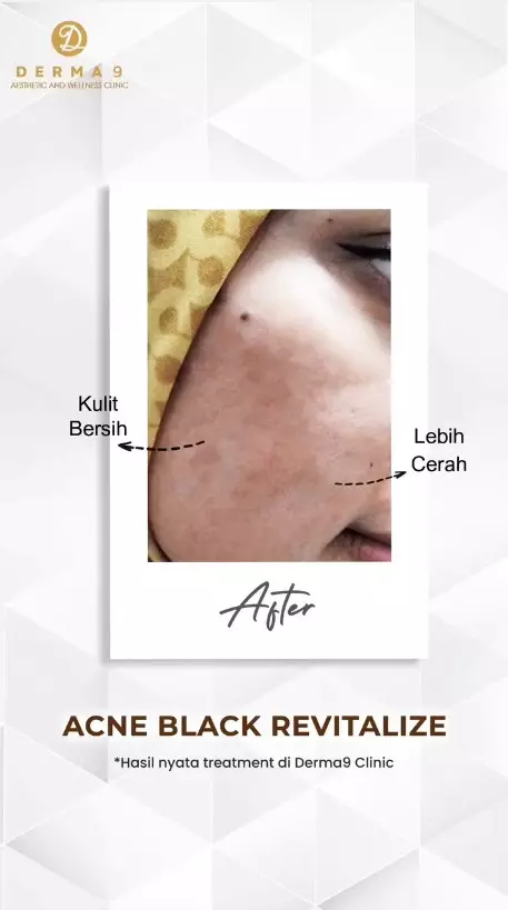 Treatment Acne Black Revitaliza