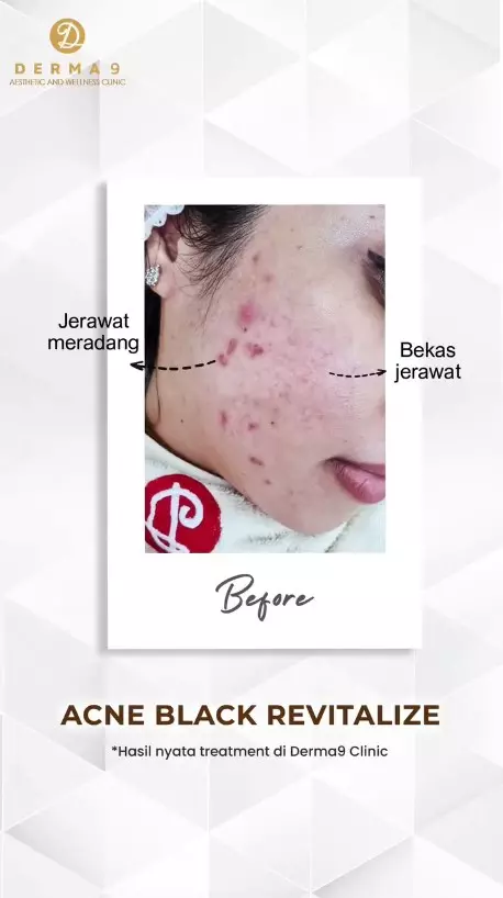 Treatment Acne Black Revitaliza