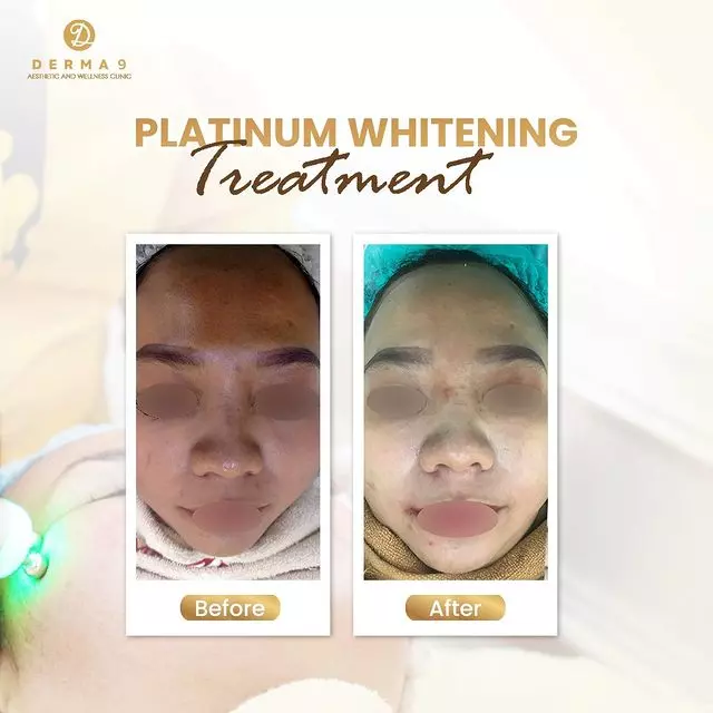platinum whitening