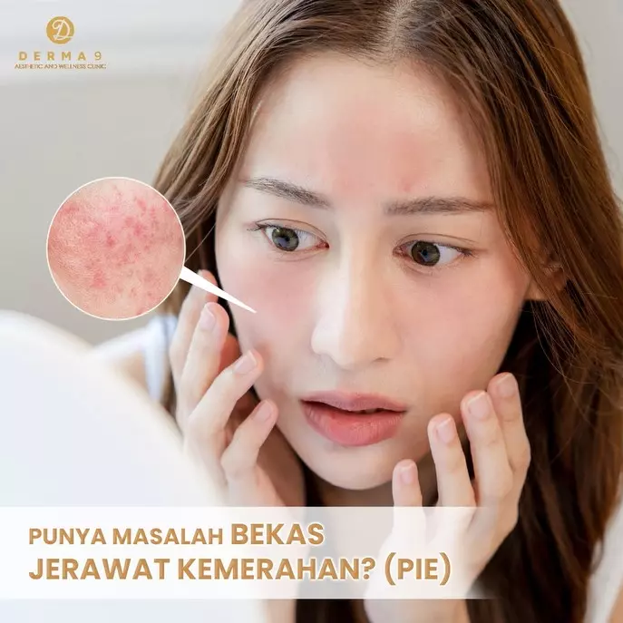 jerawat